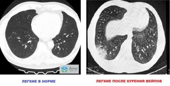 Иллюстрация: Телеграм-канал управления Роспотребнадзора по Томской области